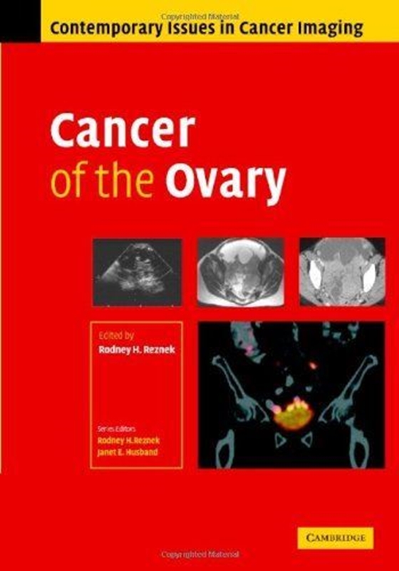resm Cancer of the Ovary