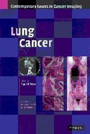 Resim Lung Cancer