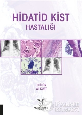 Resim Hidatid Kist Hastalığı